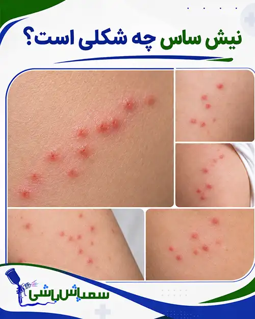 نیش ساس چه شکلی است؟