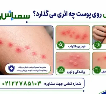 نیش ساس روی پوست چه اثری می گذارد؟