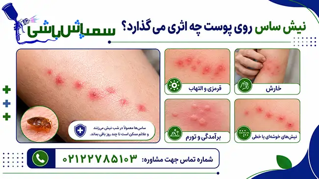 نیش ساس روی پوست چه اثری می گذارد؟